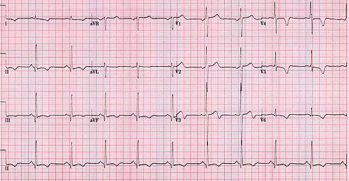 DVA2555 (CardioNetworks ECGpedia).jpg