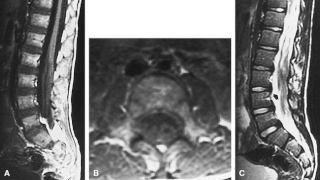 Dejerine–Sottas disease Medical condition