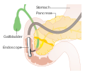 Detailed diagram of an endoscopic retrograde cholangio pancreatography (ERCP) CRUK 001.svg