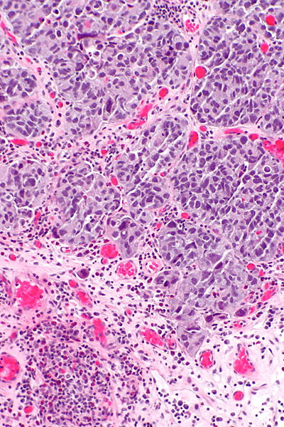 File:High-grade papillary urothelial carcinoma - inv -- intermed mag.jpg