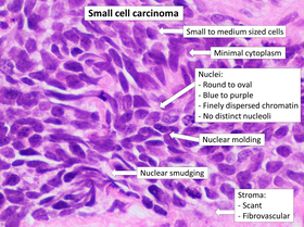 Histopathology of small-cell carcinoma, with typical findings. Histopathology of small cell carcinoma, annotated.png
