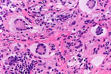 Histopathology of juvenile xanthogranuloma characteristiclaly shows scattered Touton giant cells. Juvenile xanthogranuloma - very high mag.jpg