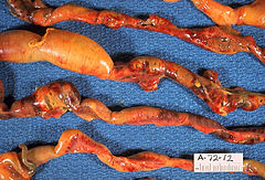 Close-up of intestine of infant showing necrosis and pneumatosis intestinalis (autopsy)