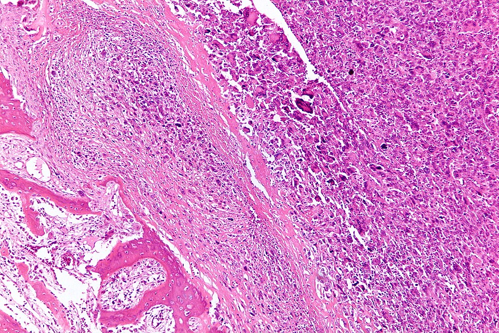 Osteosarcoma-avatar