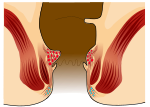 Miniatura per Desarterialització hemorroidal transanal