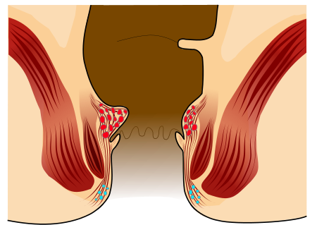 ไฟล์:Piles Grade 1.svg