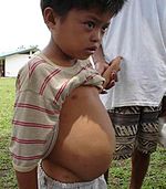 Mukomana ane makore 11 ane mvura mudumbu uye BP yemutsinga kana kuti portal hypertension zvichikonzerwa neschistosomiasis (Agusan del Sur, Philippines)