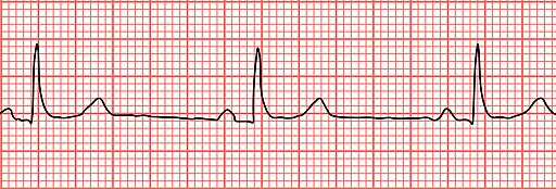 Sinus Bradycardia