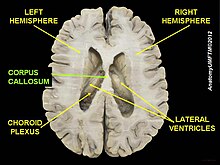 Corpus callosum Slide1oo.JPG