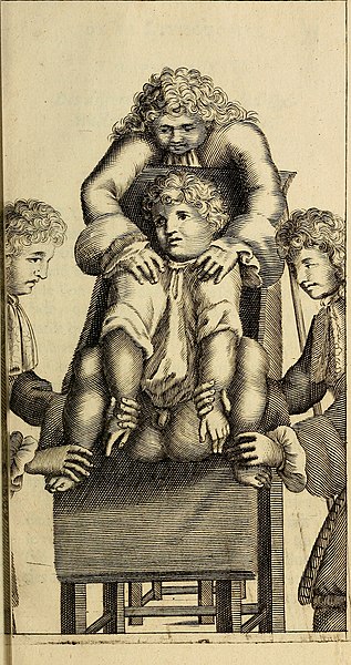 File:Traite' de la lithotomie, ou, De l'extraction de la pierre, hors de la vessie - enrichy de figures necessaires pour representer la maniére de sonder, les instrumens propres, le malade dans l'operation (14750197646).jpg