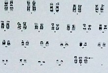 Chromosomes numbered 1 to 46, all with 2 copies except the X chromosome with 3