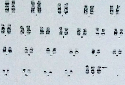 46 хромосом 1. Кариотип человека с синдромом Дауна. 46 XX кариотип. Кариотип 46 ХХ.
