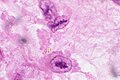 Anitschkow-Zellen bei rheumatischer Myokarditis