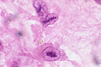 H&E stain demonstrating Anitschkow cells in rheumatic heart disease. Anitschkow Myocytes in an Aschoff Body, Rheumatic Myocarditis.jpg