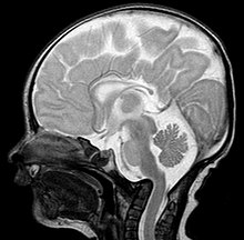 Basilar invagination in an infant with Wolf-Hirschhorn syndrome. Basilaere Impression bei Wolf-Hirschhorn-Syndrom - MRT T2 sag.jpg