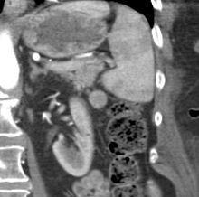 CT scan of an accessory spleen.jpg