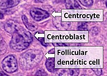 Histologic comparison of cell types in a germinal center, H&E stain:
- Centrocytes are small to medium size with angulated, elongated, cleaved, or twisted nuclei.
- Centroblasts are larger cells containing vesicular nuclei with one to three basophilic nucleoli apposing the nuclear membrane.
- Follicular dendritic cells have round nuclei, centrally located nucleoli, bland and dispersed chromatin, and flattening of adjacent nuclear membrane. Centrocyte, centroblast and follicular dendritic cell in a follicular lymphoma.jpg