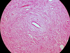 Classic Invasive Lobular Carcinoma of the Breast (6959258451).jpg