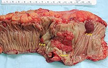 Opened colectomy specimen representing the presence of colorectal cancer. Colon cancer.jpg