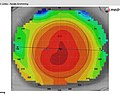 Miniatuur voor Topograaf (optometrie)