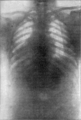 Fig. 27. — Photographie d'un thorax féminin sans corset (cliché Ducretet).