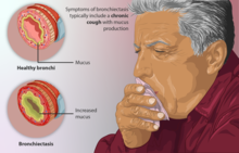 Depiction of a person suffering from Bronchiectasis.png