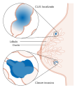 Diagram showing lobular carcinoma in situ (LCIS) CRUK 166.svg