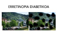 Erretinopia diabetikoa
