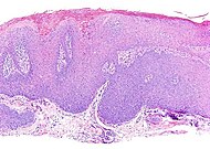 Low-magnification micrograph of oral bowenoid papulosis.jpg