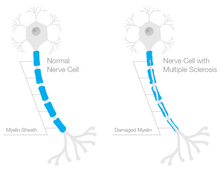 This diagram shows the myelin sheath around axons of healthy neurons looks like, and the result of demyelination of neurons in Multiple Sclerosis. Myelin sheath damage in multiple sclerosis.png