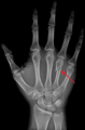 A fractured right hand fourth metacarpal (boxer's fracture).