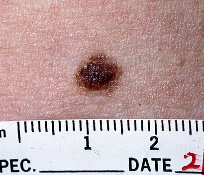 Nevus NCI.jpg