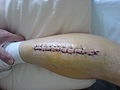 Scars 6 days post surgery.JPG
