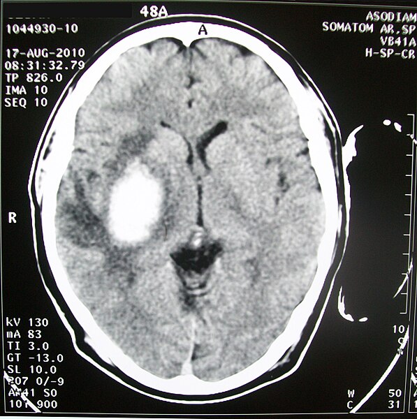 File:TAC de craneo hematoma cerebral.jpg