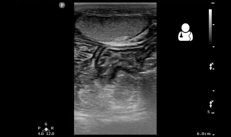 File:UOTW 16 - Ultrasound of the Week 1.webm - Wikipedia