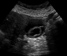 Radiologia dell'apparato genitale femminile e della gravidanza - Wikipedia