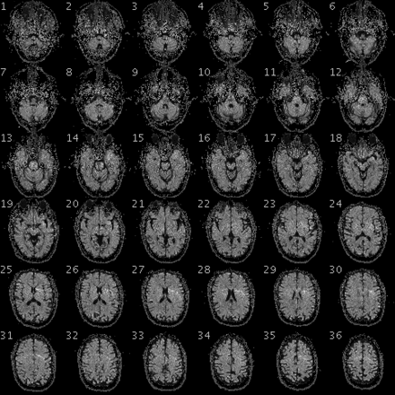 fMRI image of the brain of a participant in the Personal Genome Project.