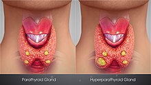 3D Medical Animation still shot showing Hyperparathyroidism