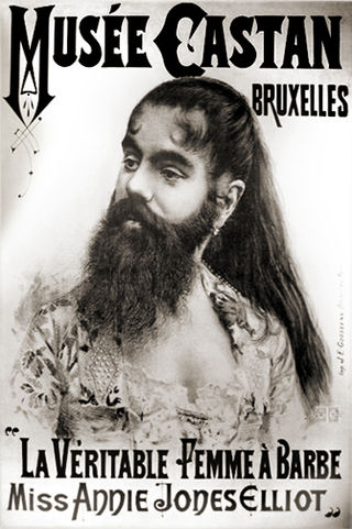 <span class="mw-page-title-main">Bearded lady</span> Woman with naturally occurring facial hair