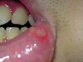 The lower lip is retracted, revealing aphthous ulcers on the labial mucosa (note erythematous "halo" surrounding ulcers) Aphthous ulcer.jpg
