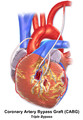 Illustration of Triple bypass