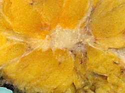 An invasive ductal carcinoma of the breast (pale area at the center) surrounded by spikes of whitish scar tissue and yellow fatty tissue