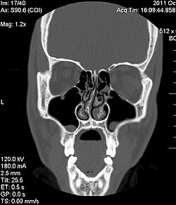 A CT scan of the head showing the inner workings of the nose with a deviated septum