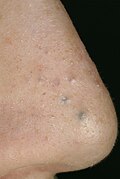May 21: Eccrine hidrocystoma, an adenoma of the sweat glands