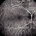 Thumbnail for Indocyanine green angiography