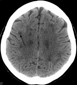 <span class="mw-page-title-main">Leukoencephalopathy</span> A term to describe all brain white matter diseases