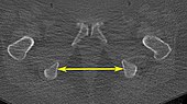 Low-dose CT scan of intertuberous diameter, axial plane, annotated.jpg