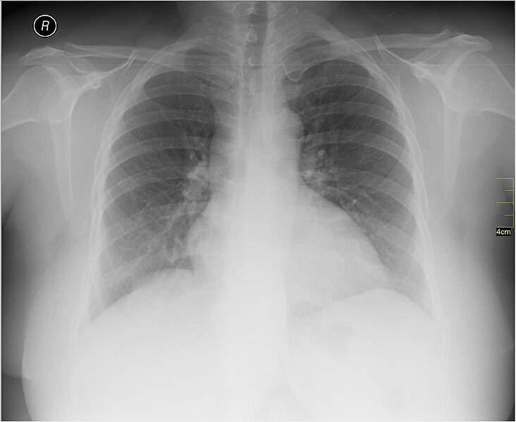 File:Medical X-Ray imaging VFD07 nevit.jpg