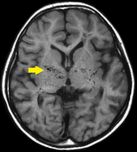 Moyamoya disease-MRI T1.png