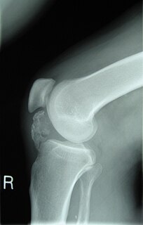 <span class="mw-page-title-main">Osteochondroma</span> Medical condition